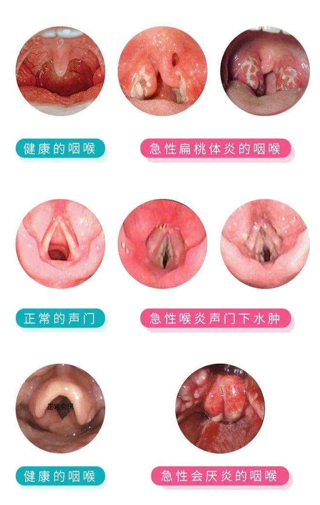 关于7个月宝宝喉咙有痰怎么办的详细解答